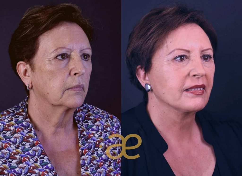 Antes y Después 1