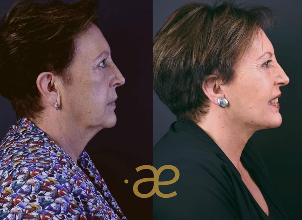 Antes y Después 2