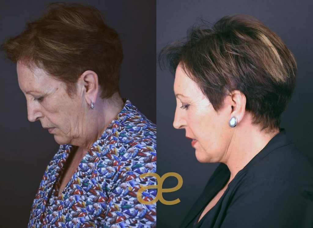 Antes y Después 3